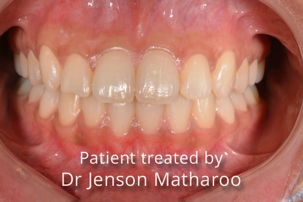 After Fixed Metal Braces in Dumfries