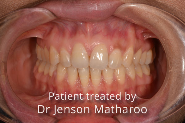 after Discreet White Braces in Dumfries